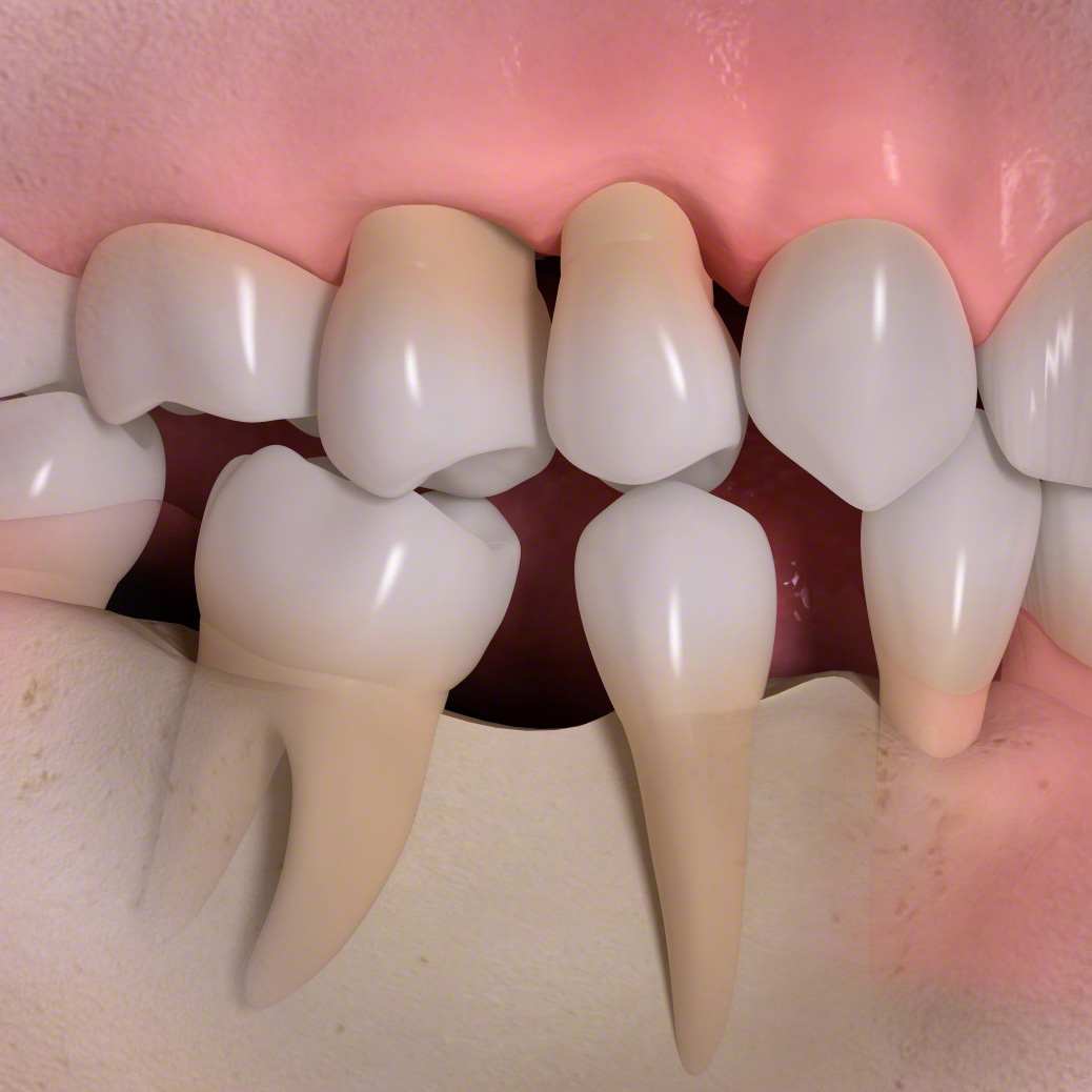 歯並びの悪化