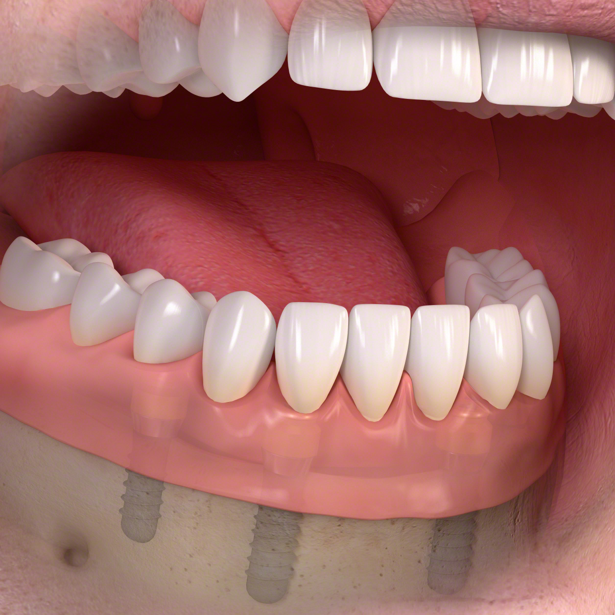 義歯に付けた凹型の装置と接続させる(インプラントオーバーデンチャータイプ）