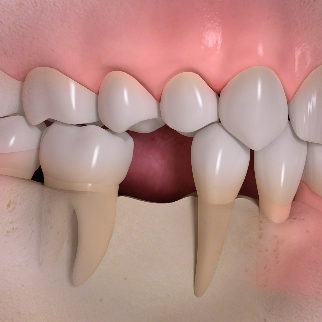 歯の喪失